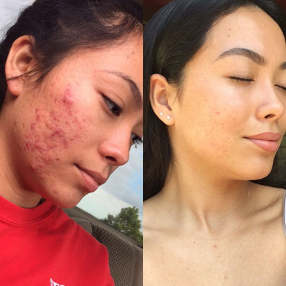 ClearSkin™ S10 ZeroAcné